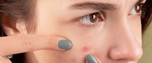 Descubra por que as espinhas aparecem no corpo